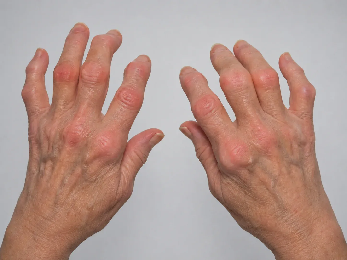 Rheumatoid arthritis — hands with swollen, arthritic finger joints